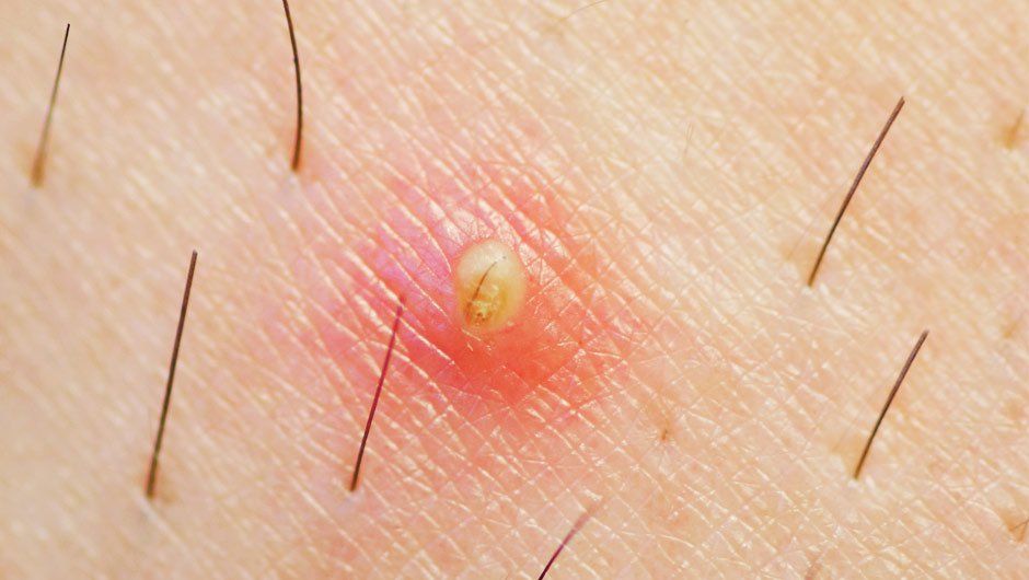 Causes And 8 Remedies Of Ingrown Hair Bumps New Health Advisor